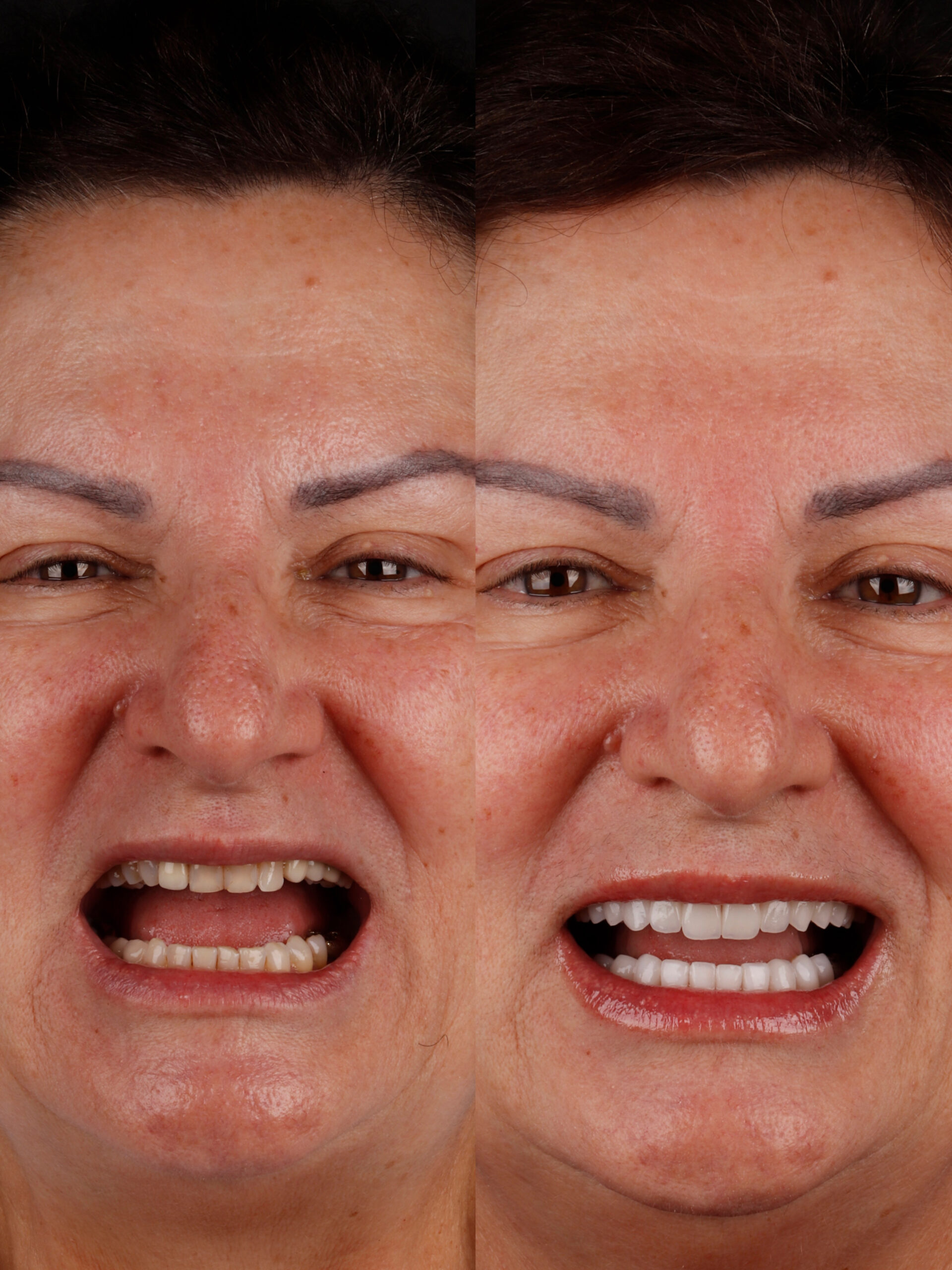 Caso de lentes de contato dental
