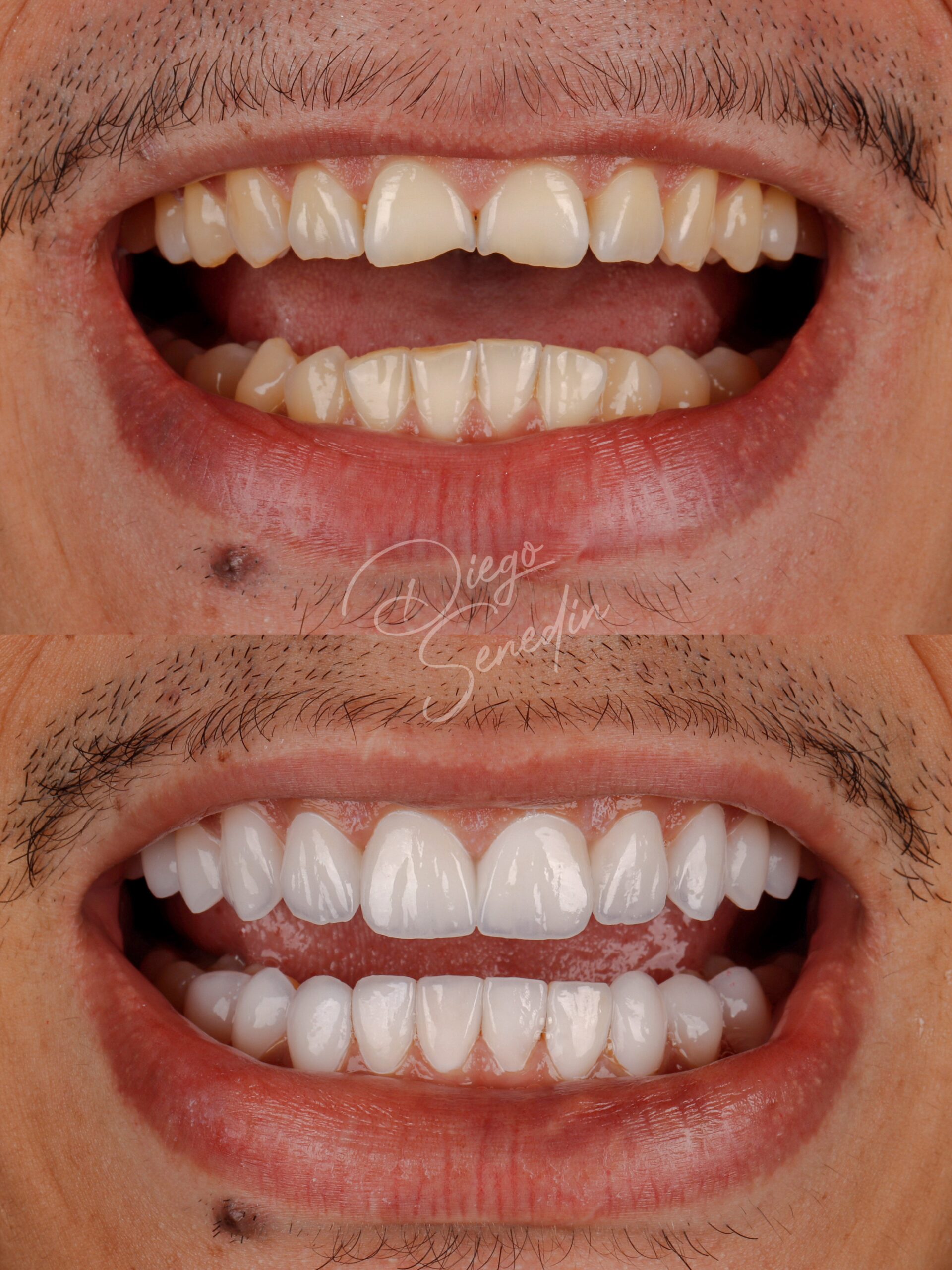 Caso de lentes de contato dental