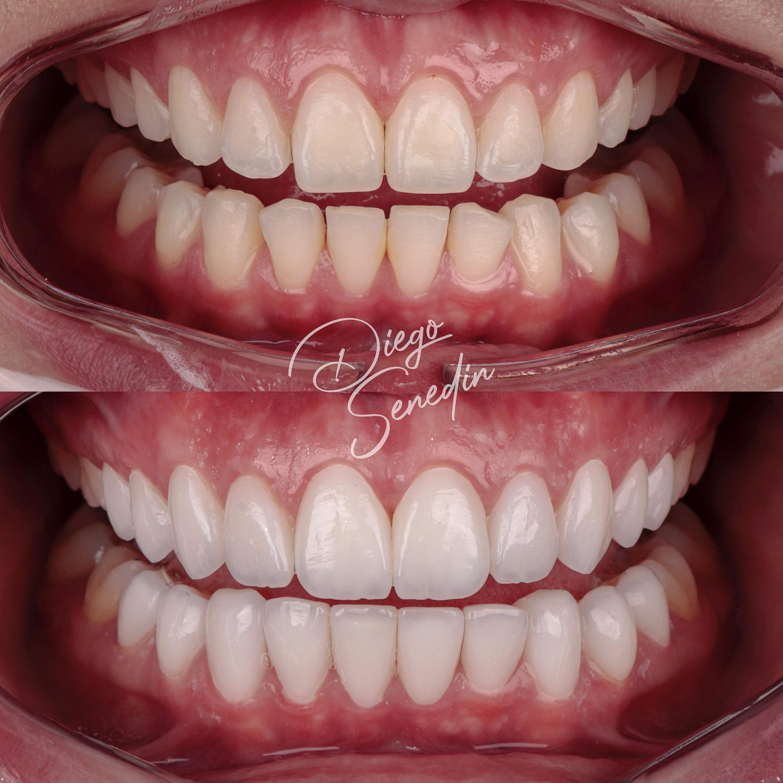 Caso de lentes de contato dental