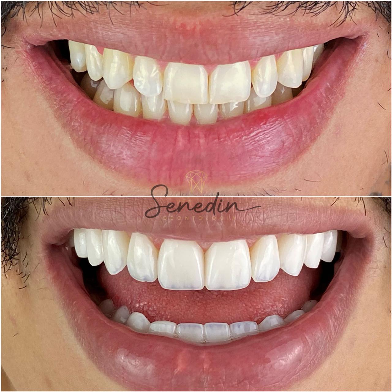 Caso de lentes de contato dental