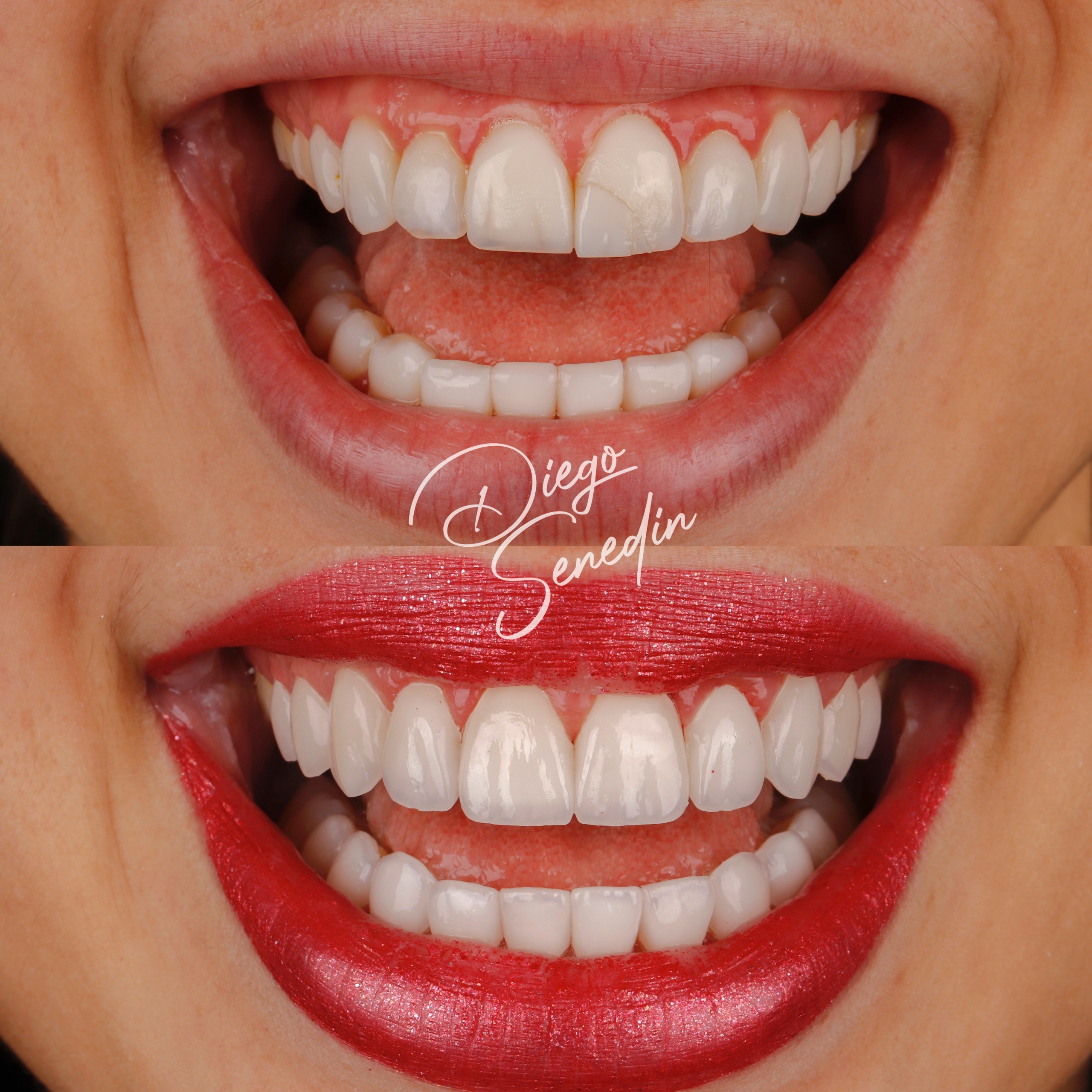Caso de lentes de contato dental