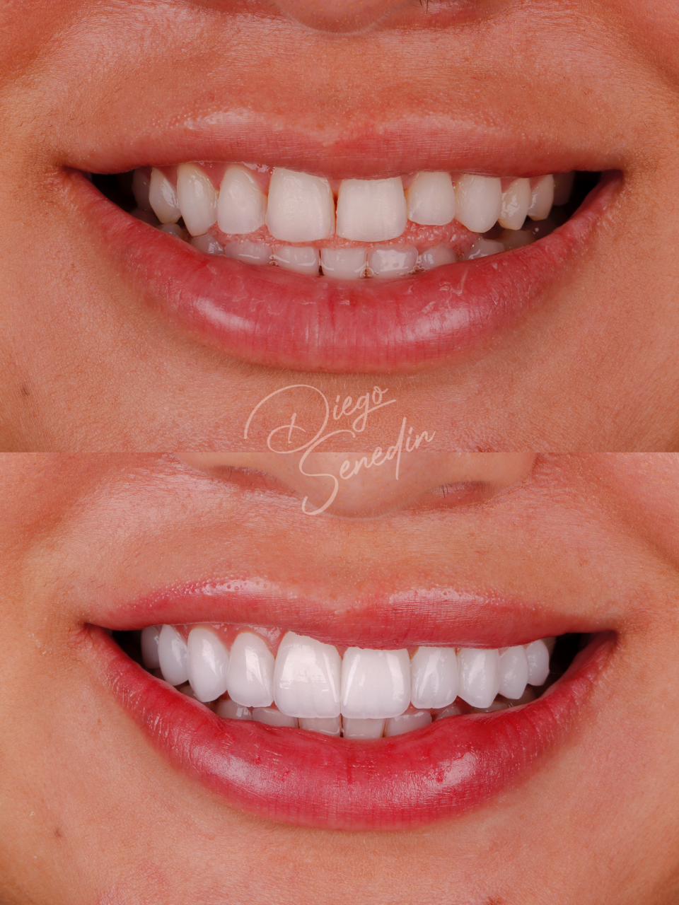 Caso de lentes de contato dental