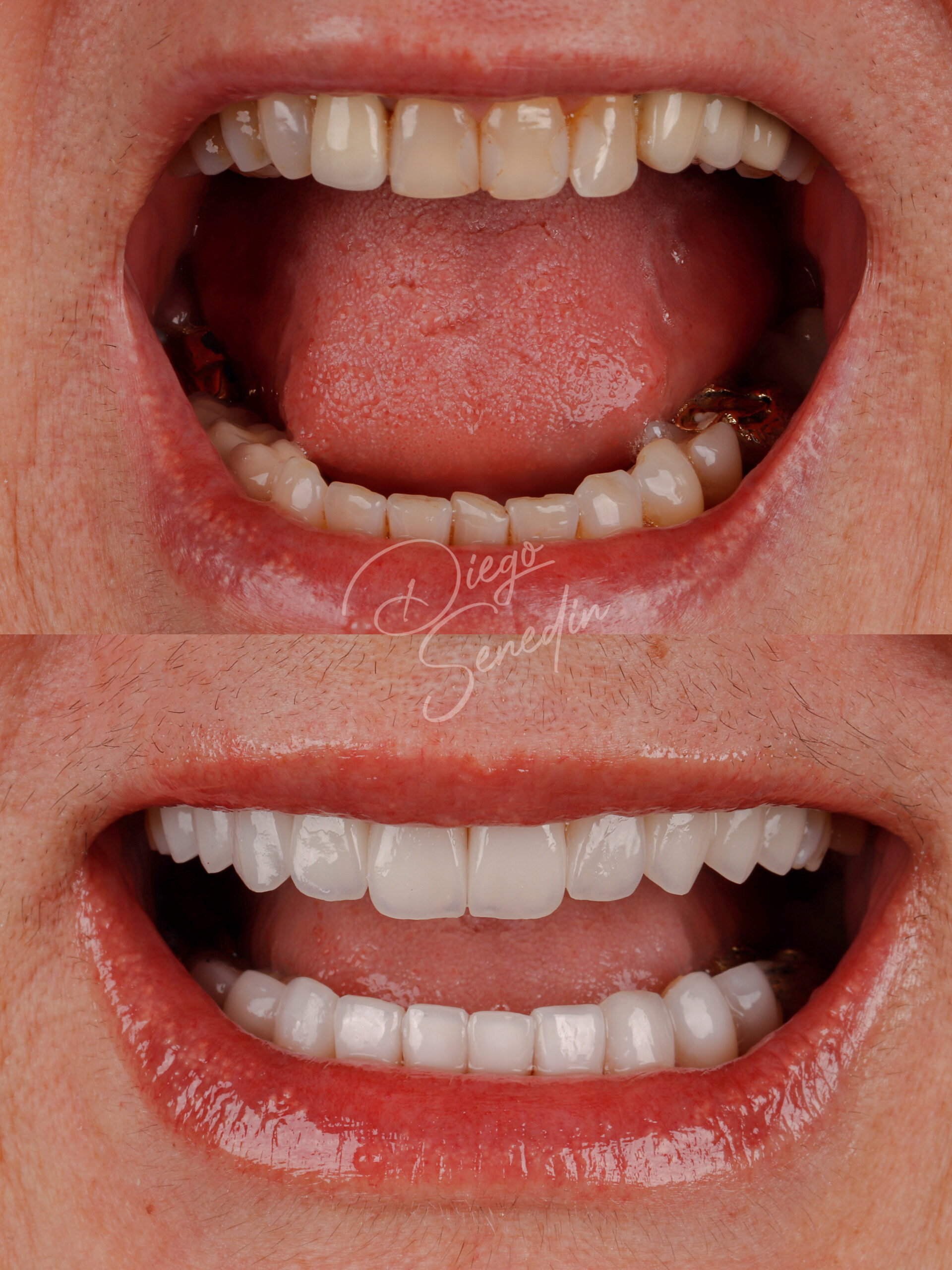 Caso de lentes de contato dental