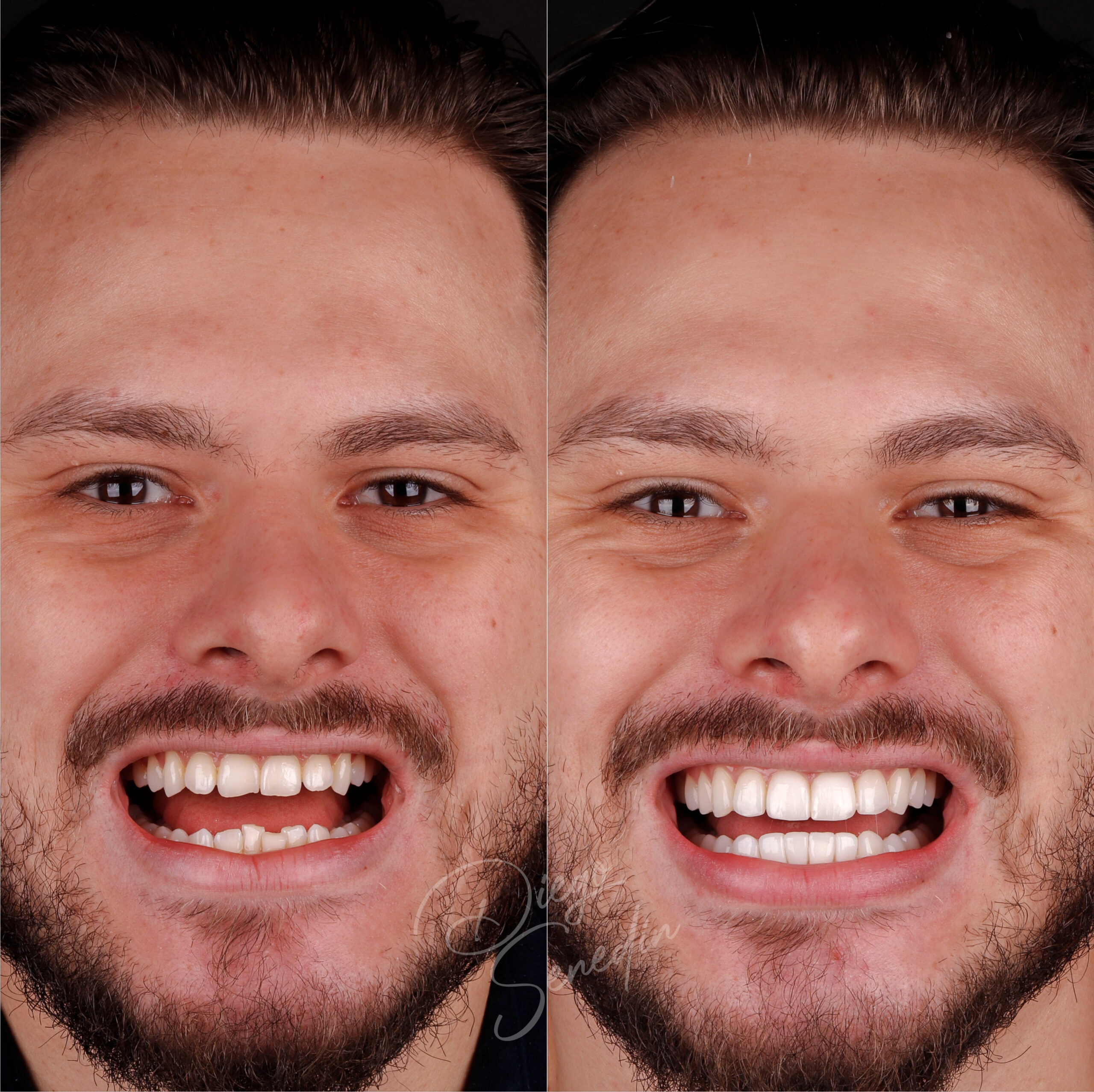 Caso de lentes de contato dental