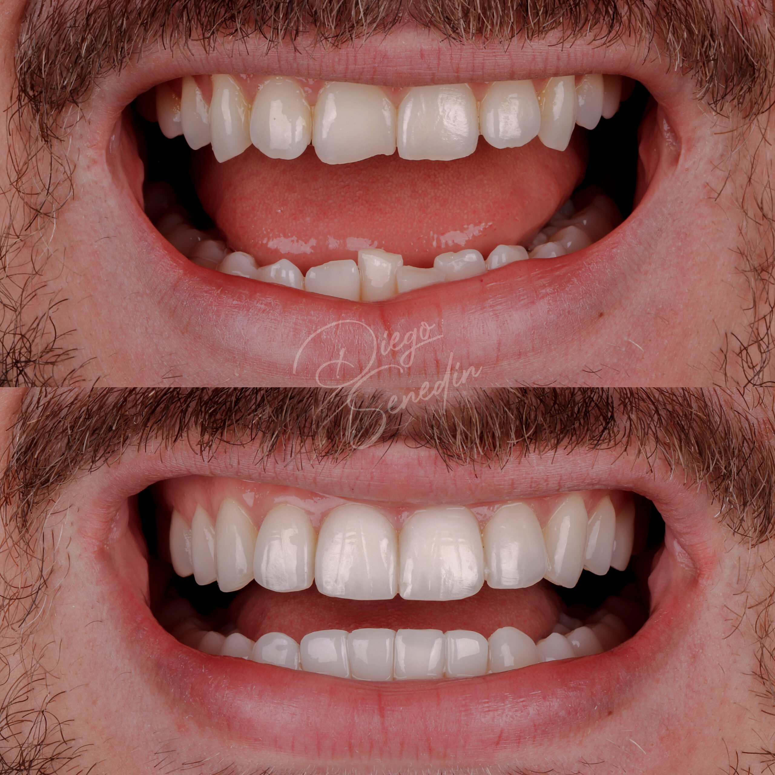 Caso de lentes de contato dental